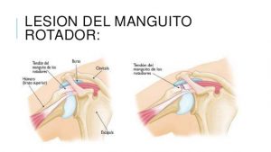 Guía para recuperarse de una lesión en el hombro por caída: Ejercicios y recomendaciones.